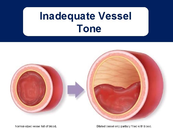 Inadequate Vessel Tone Fig. 15 -03 Don’t have art yet - WDS 