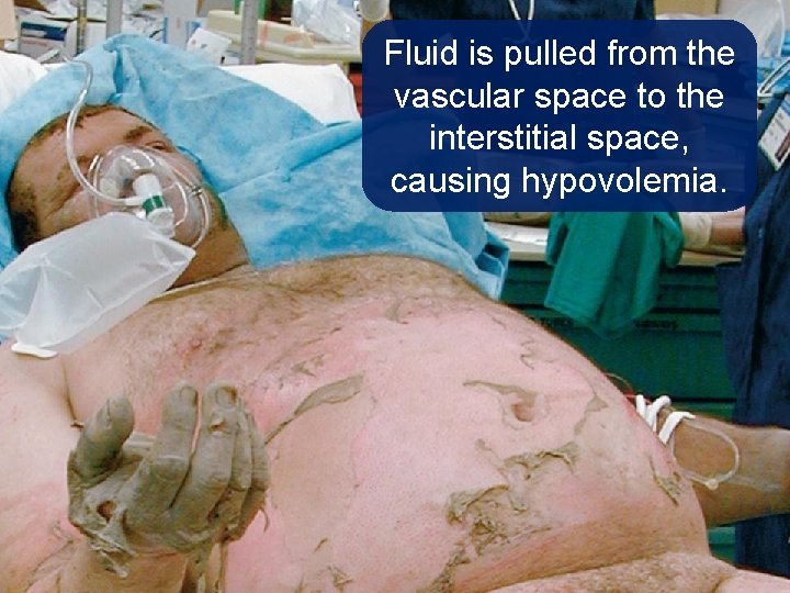 Fluid is pulled from the vascular space to the interstitial space, causing hypovolemia. 