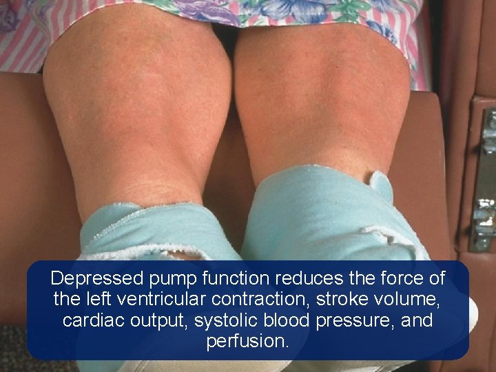 Depressed pump function reduces the force of the left ventricular contraction, stroke volume, cardiac