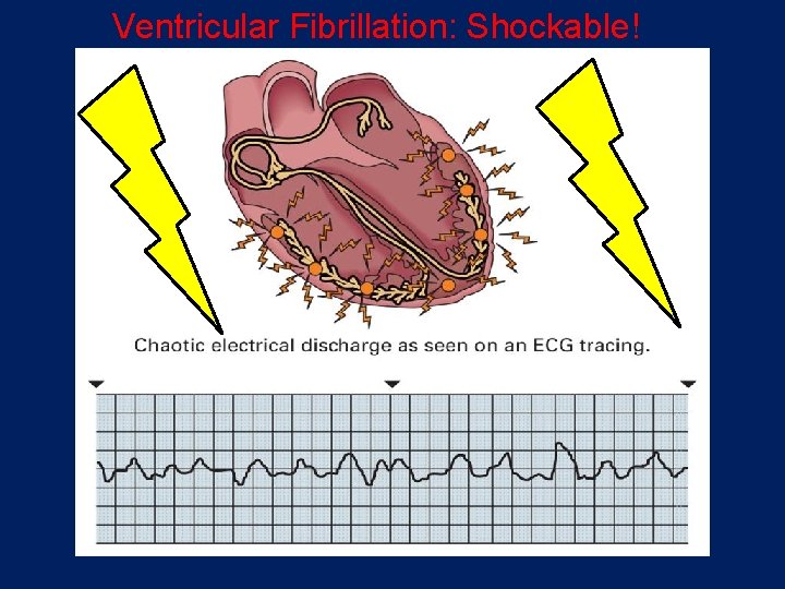 Ventricular Fibrillation: Shockable! 