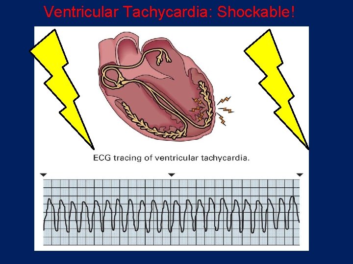 Ventricular Tachycardia: Shockable! 