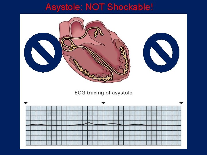Asystole: NOT Shockable! 