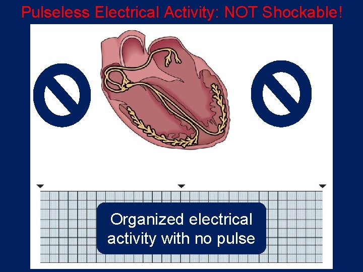 Pulseless Electrical Activity: NOT Shockable! Organized electrical activity with no pulse 