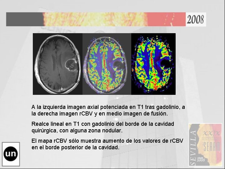 A la izquierda imagen axial potenciada en T 1 tras gadolinio, a la derecha