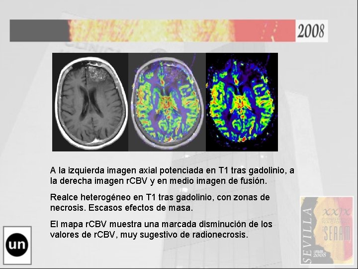 A la izquierda imagen axial potenciada en T 1 tras gadolinio, a la derecha