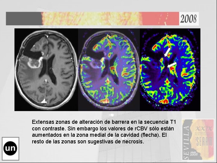 Extensas zonas de alteración de barrera en la secuencia T 1 contraste. Sin embargo