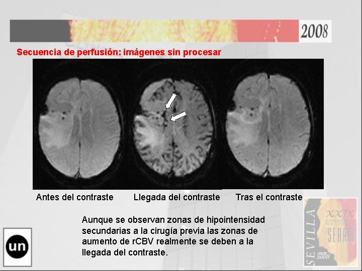 Secuencia de perfusión: imágenes sin procesar Antes del contraste Llegada del contraste Tras el