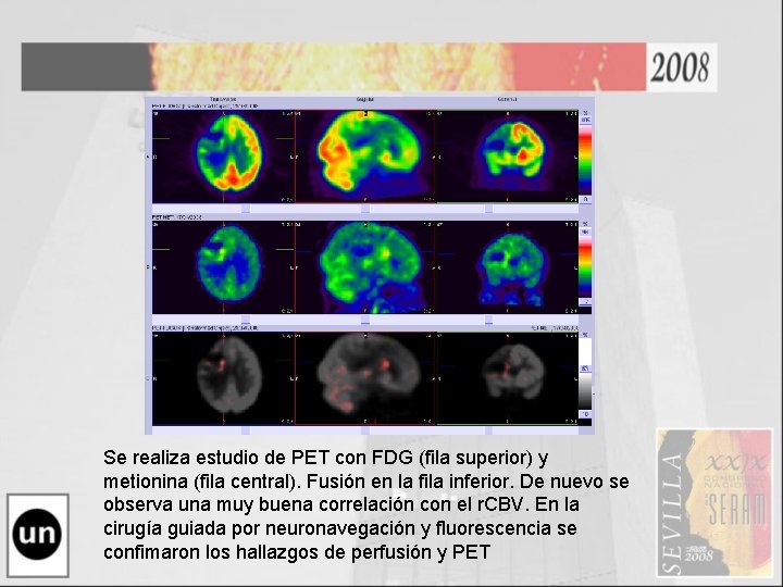 Se realiza estudio de PET con FDG (fila superior) y metionina (fila central). Fusión