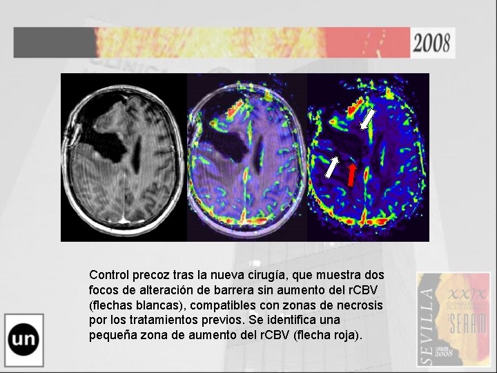Control precoz tras la nueva cirugía, que muestra dos focos de alteración de barrera