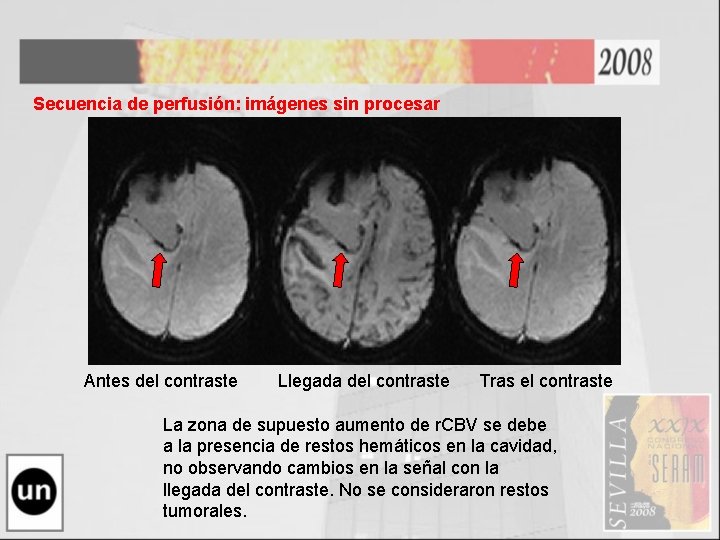Secuencia de perfusión: imágenes sin procesar Antes del contraste Llegada del contraste Tras el