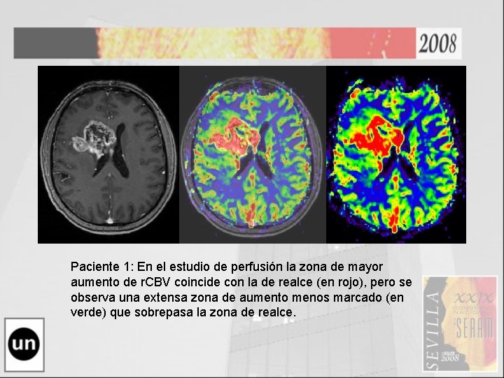 Paciente 1: En el estudio de perfusión la zona de mayor aumento de r.