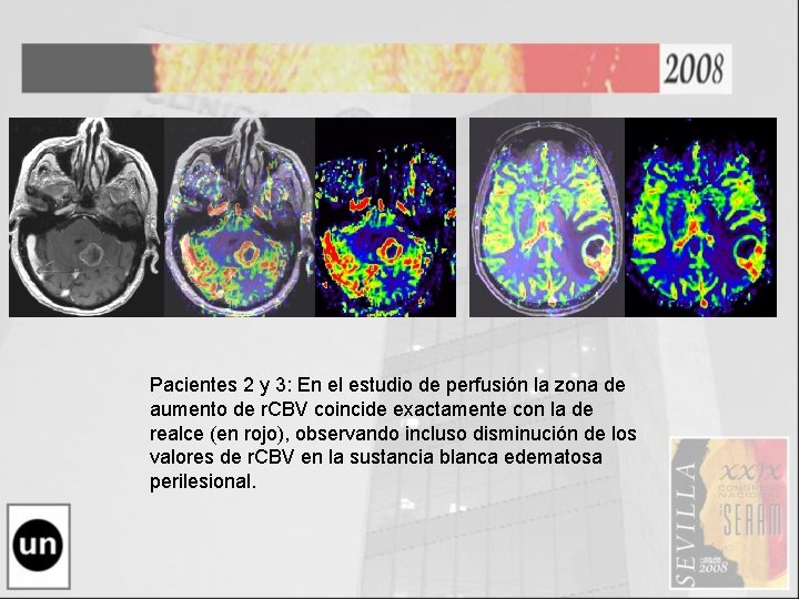 Pacientes 2 y 3: En el estudio de perfusión la zona de aumento de