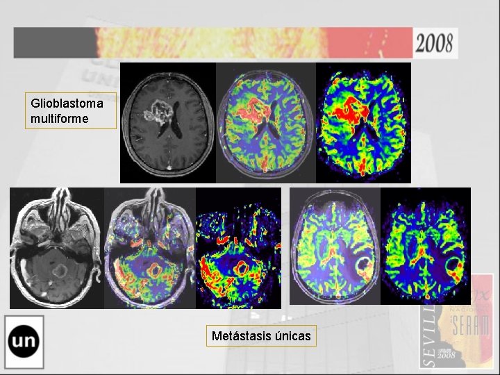 Glioblastoma multiforme Metástasis únicas 