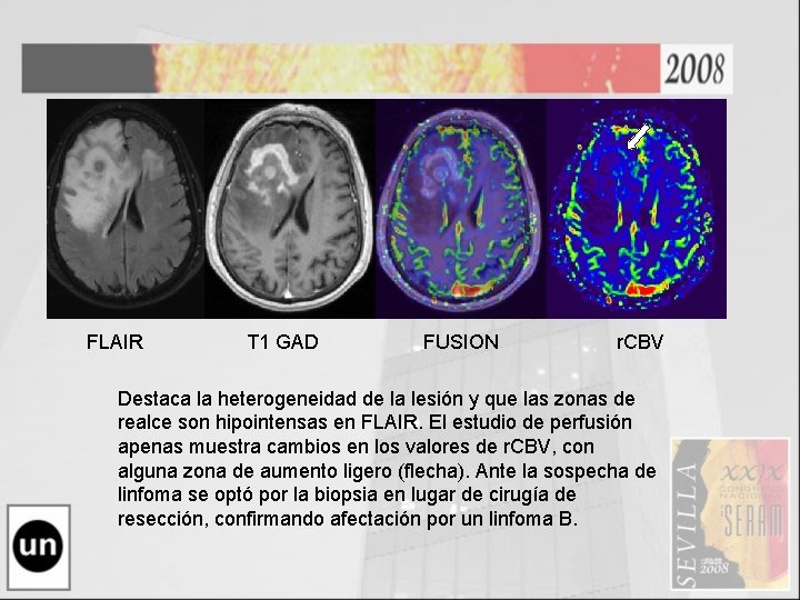 FLAIR T 1 GAD FUSION r. CBV Destaca la heterogeneidad de la lesión y