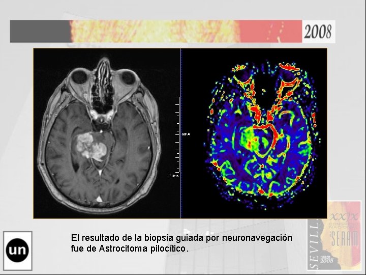 El resultado de la biopsia guiada por neuronavegación fue de Astrocitoma pilocítico. 