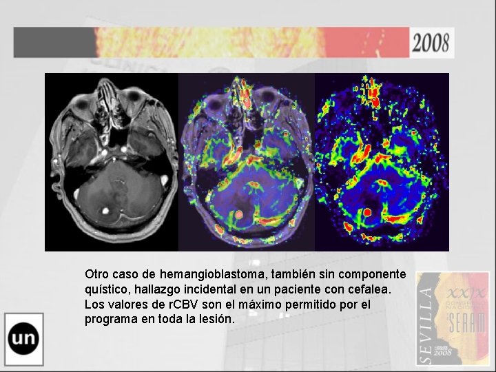 Otro caso de hemangioblastoma, también sin componente quístico, hallazgo incidental en un paciente con