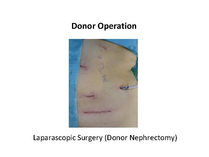 Donor Operation Laparascopic Surgery (Donor Nephrectomy) 