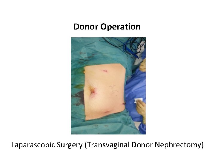 Donor Operation Laparascopic Surgery (Transvaginal Donor Nephrectomy) 