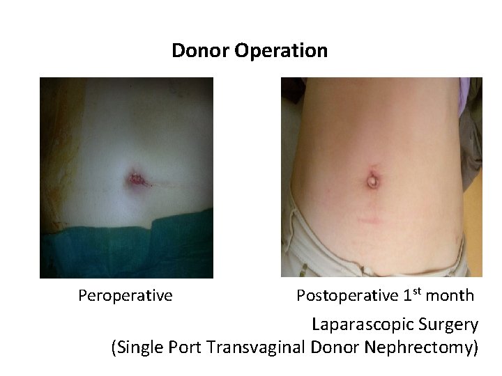 Donor Operation Peroperative Postoperative 1 st month Laparascopic Surgery (Single Port Transvaginal Donor Nephrectomy)