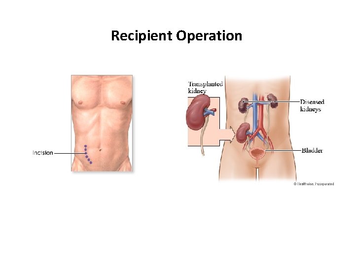 Recipient Operation 