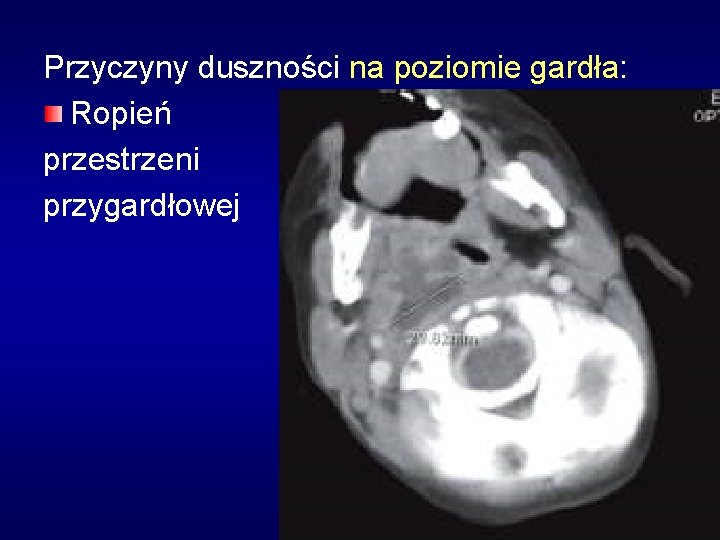 Przyczyny duszności na poziomie gardła: Ropień przestrzeni przygardłowej 