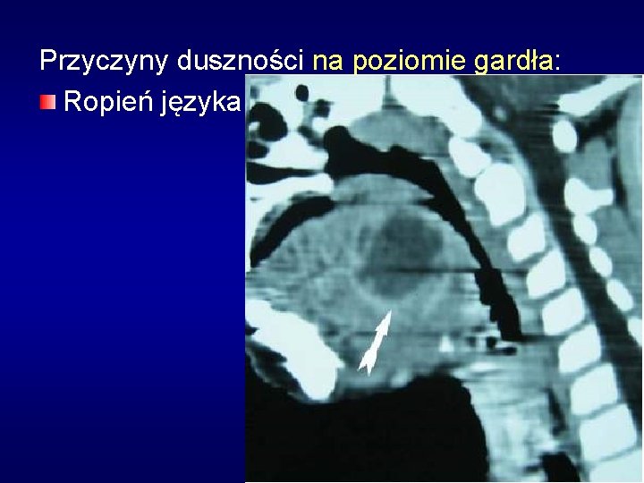 Przyczyny duszności na poziomie gardła: Ropień języka 