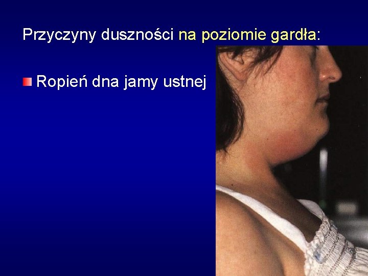 Przyczyny duszności na poziomie gardła: Ropień dna jamy ustnej 