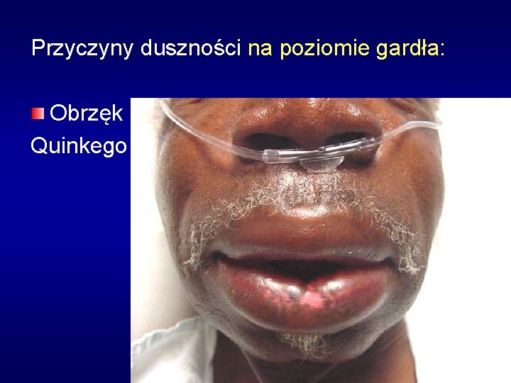 Przyczyny duszności na poziomie gardła: Obrzęk Quinkego 