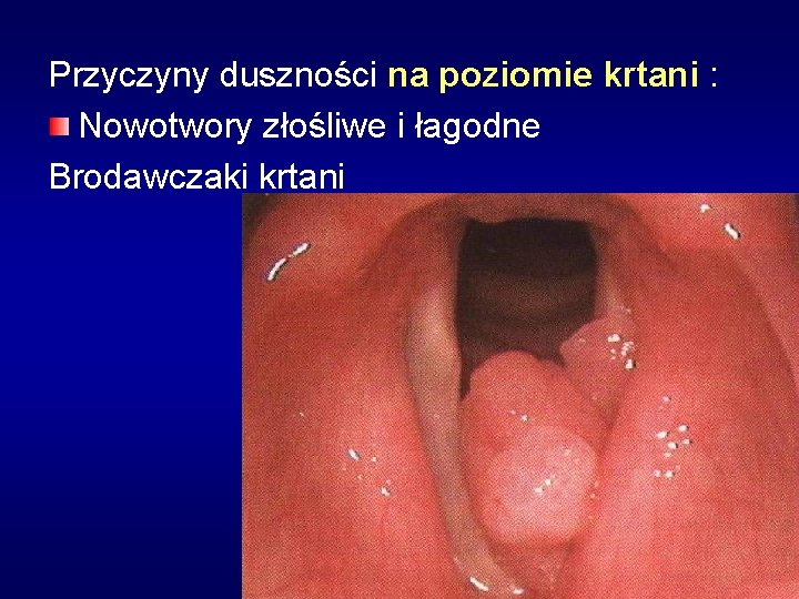 Przyczyny duszności na poziomie krtani : Nowotwory złośliwe i łagodne Brodawczaki krtani 