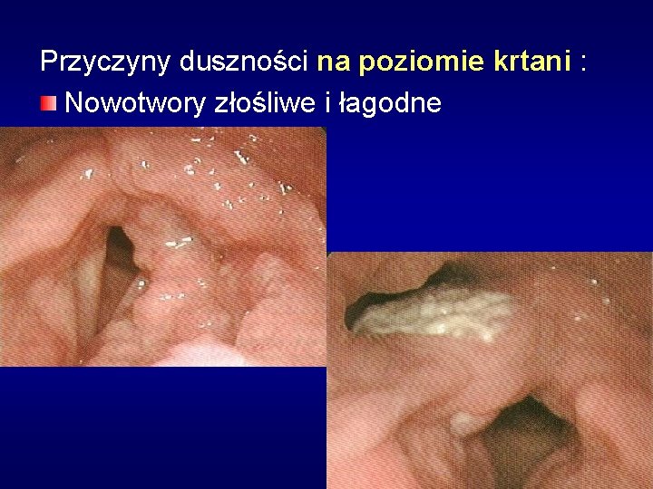 Przyczyny duszności na poziomie krtani : Nowotwory złośliwe i łagodne 
