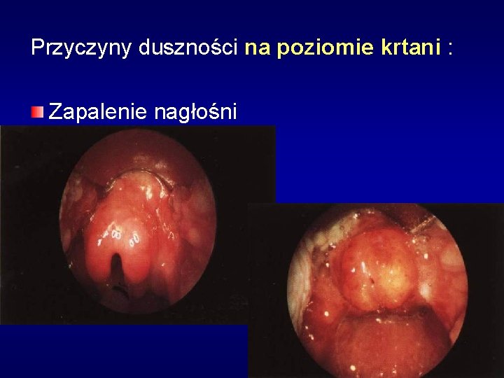 Przyczyny duszności na poziomie krtani : Zapalenie nagłośni 