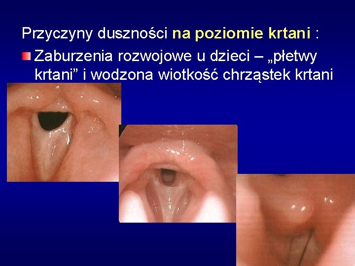 Przyczyny duszności na poziomie krtani : Zaburzenia rozwojowe u dzieci – „płetwy krtani” i