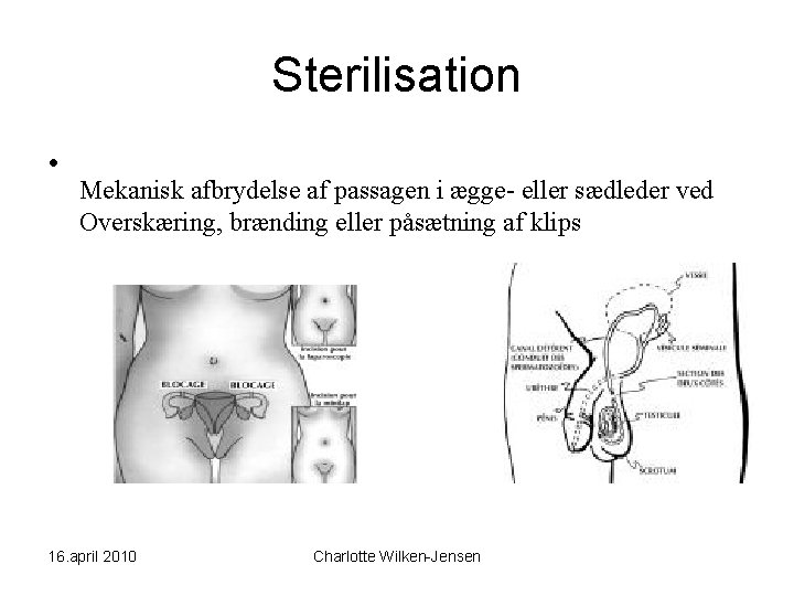 Sterilisation • Mekanisk afbrydelse af passagen i ægge- eller sædleder ved Overskæring, brænding eller