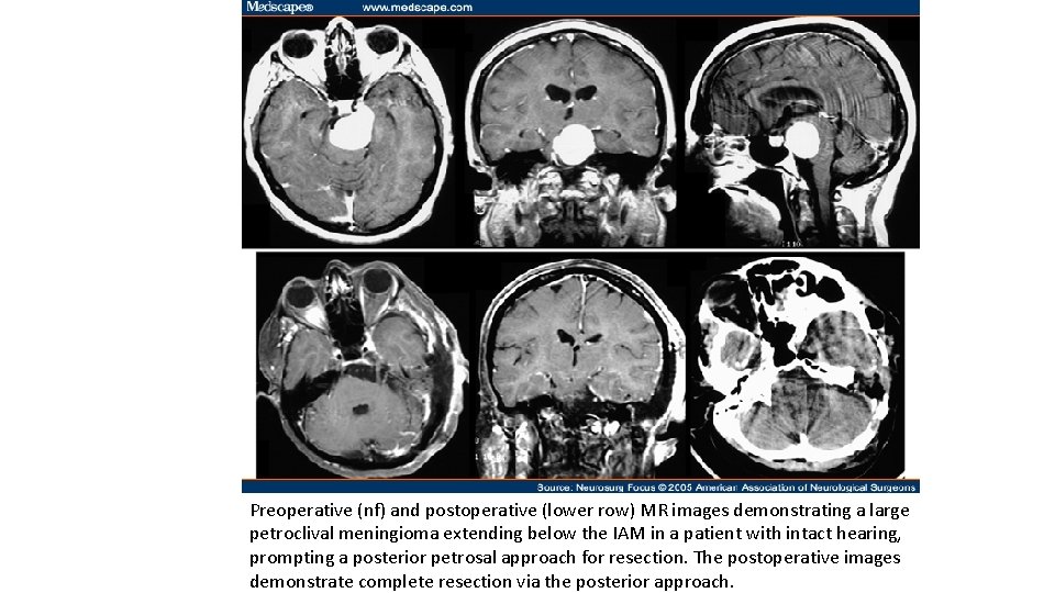 Preoperative (nf) and postoperative (lower row) MR images demonstrating a large petroclival meningioma extending