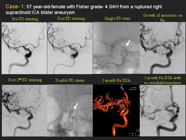 Case- 1: 57 year-old-female with Fisher grade- 4 SAH from a ruptured right supraclinoid