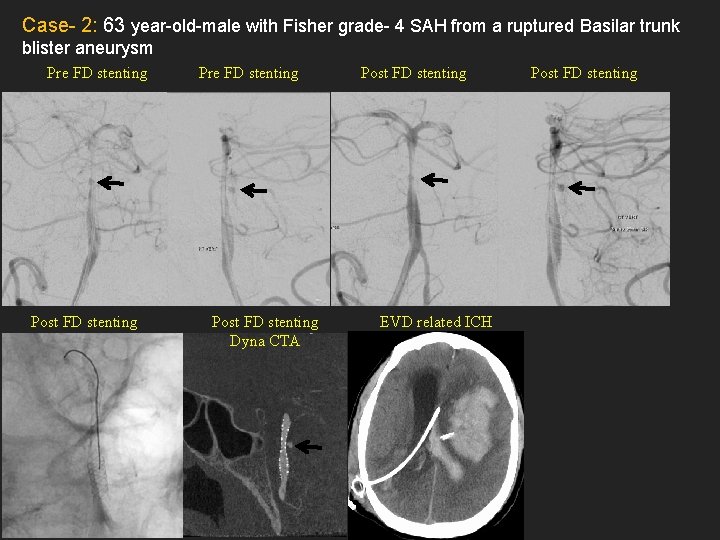 Case- 2: 63 year-old-male with Fisher grade- 4 SAH from a ruptured Basilar trunk