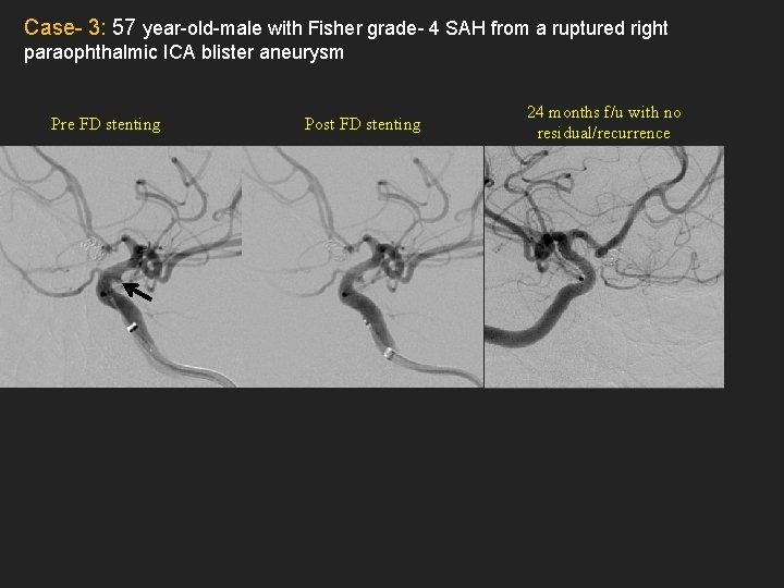 Case- 3: 57 year-old-male with Fisher grade- 4 SAH from a ruptured right paraophthalmic