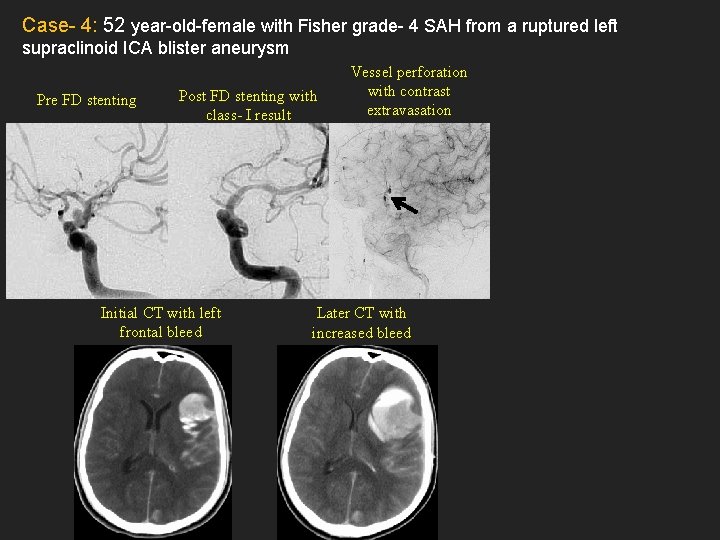 Case- 4: 52 year-old-female with Fisher grade- 4 SAH from a ruptured left supraclinoid