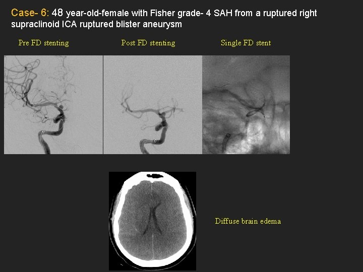 Case- 6: 48 year-old-female with Fisher grade- 4 SAH from a ruptured right supraclinoid