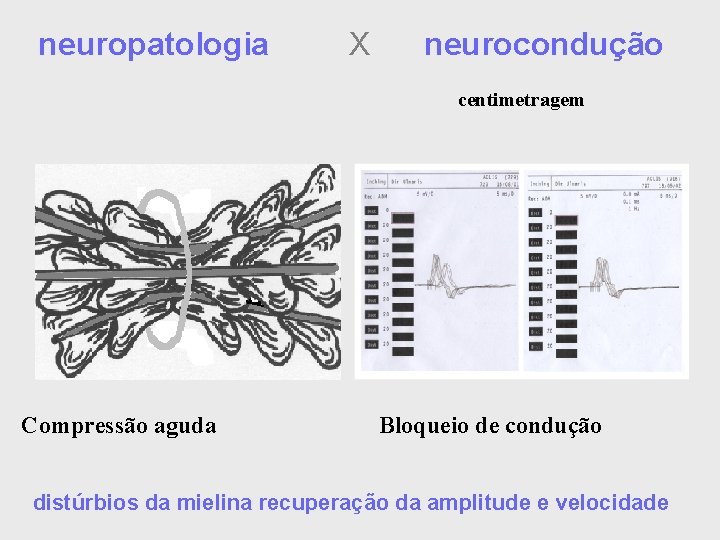 neuropatologia X neurocondução centimetragem Compressão aguda Bloqueio de condução distúrbios da mielina recuperação da