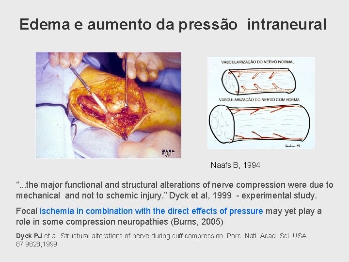 Edema e aumento da pressão intraneural Naafs B, 1994 “. . . the major