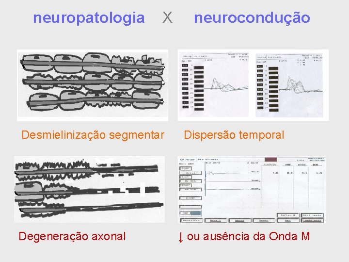 neuropatologia X Desmielinização segmentar Degeneração axonal neurocondução Dispersão temporal ↓ ou ausência da Onda
