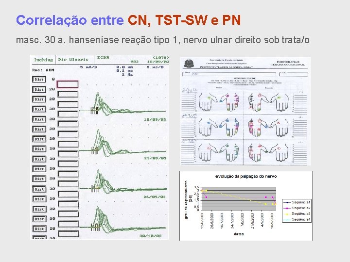 Correlação entre CN, TST-SW e PN masc. 30 a. hanseníase reação tipo 1, nervo
