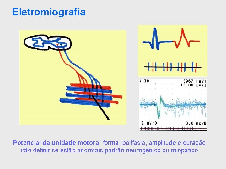 Eletromiografia Potencial da unidade motora: forma, polifasia, amplitude e duração irão definir se estão