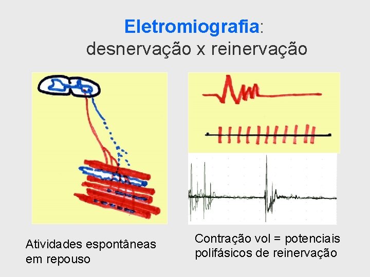 Eletromiografia: desnervação x reinervação Atividades espontâneas em repouso Contração vol = potenciais polifásicos de