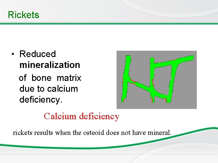 Rickets • Reduced mineralization of bone matrix due to calcium deficiency. Calcium deficiency rickets