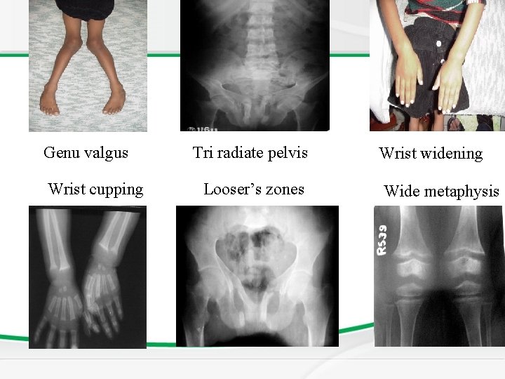 Genu valgus Wrist cupping Tri radiate pelvis Looser’s zones Wrist widening Wide metaphysis 