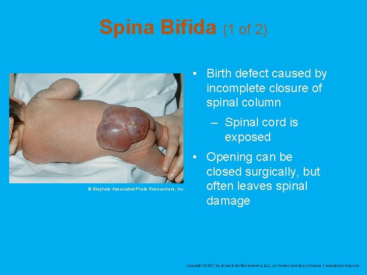 Spina Bifida (1 of 2) • Birth defect caused by incomplete closure of spinal