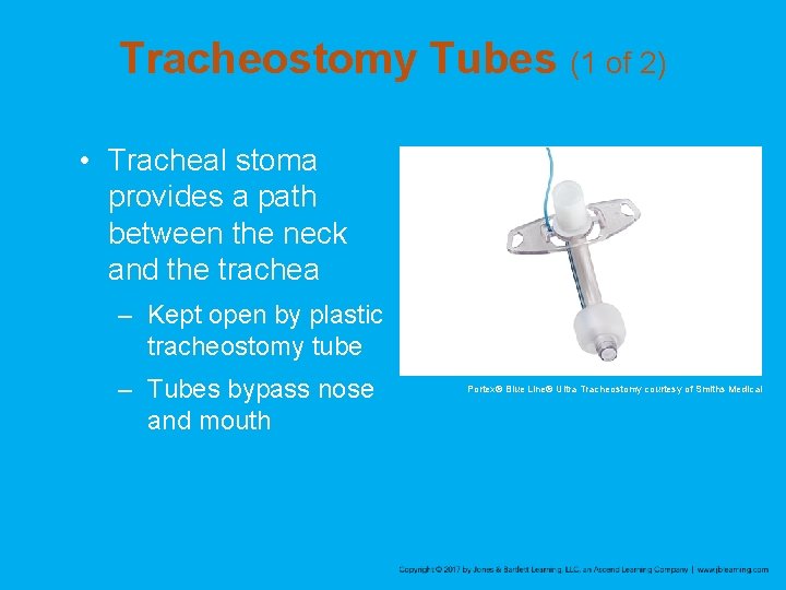 Tracheostomy Tubes (1 of 2) • Tracheal stoma provides a path between the neck