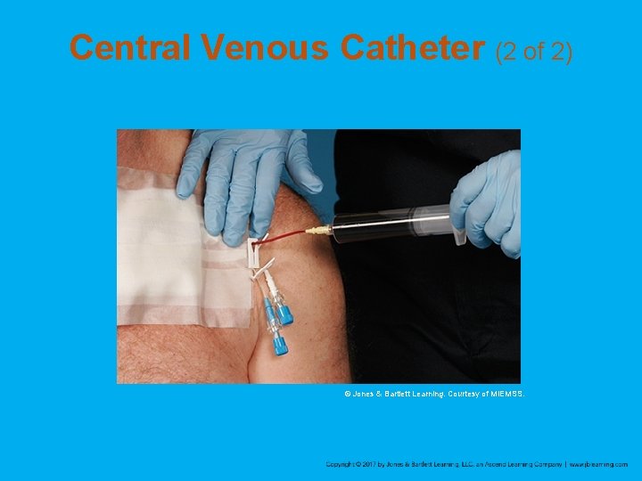 Central Venous Catheter (2 of 2) © Jones & Bartlett Learning. Courtesy of MIEMSS.